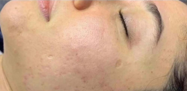 Tvář ženy po anti akné ošetřením